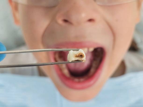 Best Emergency Treatment for Dental Infections or Abscesses in Dayton, WA